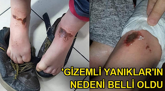 'gizemli yanıklar'ın nedeni belli oldu