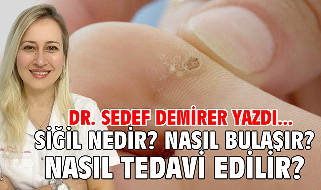 Siğil Nedir? Nasıl Bulaşır? Nasıl Tedavi Edilir?