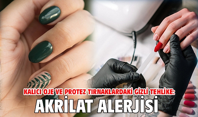 Kalıcı oje ve protez tırnaklardaki gizli tehlike: Akrilat Alerjisi