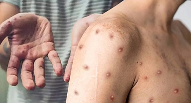 DSÖ: M çiçeği virüsü acil durum oluşturuyor