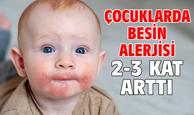 ÇOCUKLARDA BESİN ALERJİSİ 2-3 KAT ARTTI