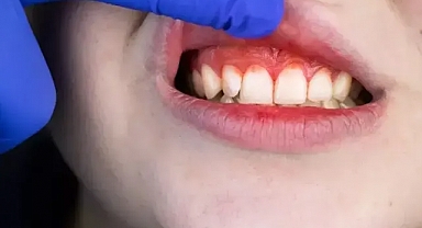 C vitamini eksikliği diş eti kanamalarına neden oluyor