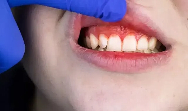 C vitamini eksikliği diş eti kanamalarına neden oluyor