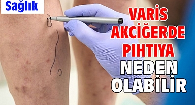 VARİS AKCİĞERDE PIHTIYA NEDEN OLABİLİR