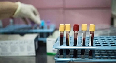 Y kuşağının yeni korkulu rüyası bu kanser türü oldu: Neden çıktığı bilinmiyor