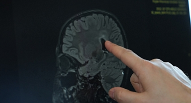 Vücuttaki aşırı kasılmaların nedeni serebral palsi olabilir