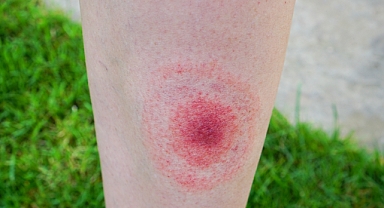 Lyme hastalığı kalıcı ve ağır tablolarla ilerleyebilir