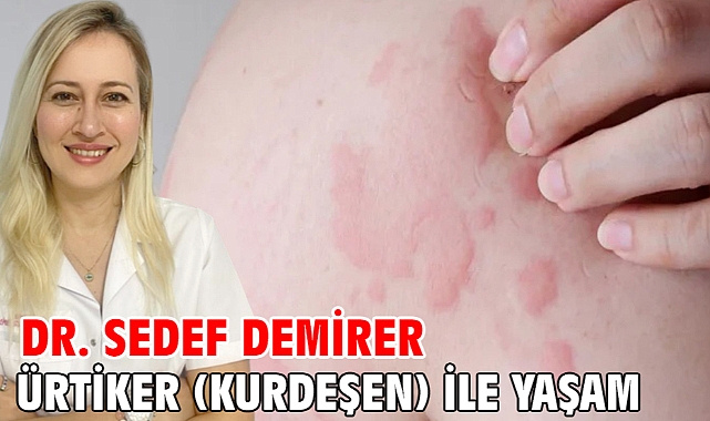 Ürtiker (Kurdeşen) ile Yaşam
