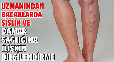 Uzmanından bacaklarda şişlik ve damar sağlığına ilişkin bilgilendirme