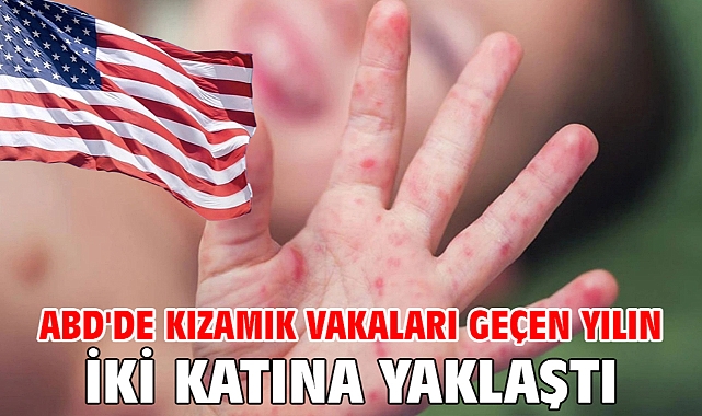 ABD'de kızamık vakaları geçen yılın iki katına yaklaştı
